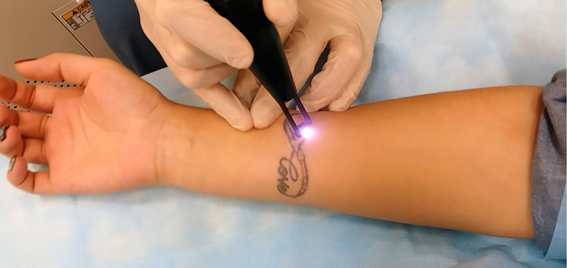 Процесс выведения Татуировки лазером